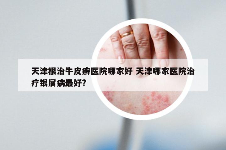 天津根治牛皮癣医院哪家好 天津哪家医院治疗银屑病最好?