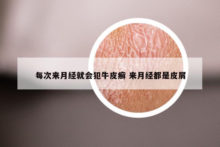 每次来月经就会犯牛皮癣 来月经都是皮屑