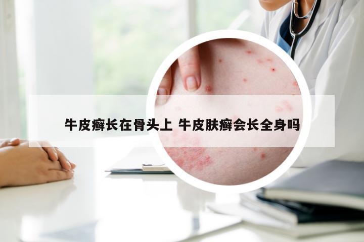 牛皮癣长在骨头上 牛皮肤癣会长全身吗