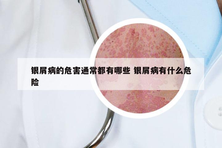 银屑病的危害通常都有哪些 银屑病有什么危险
