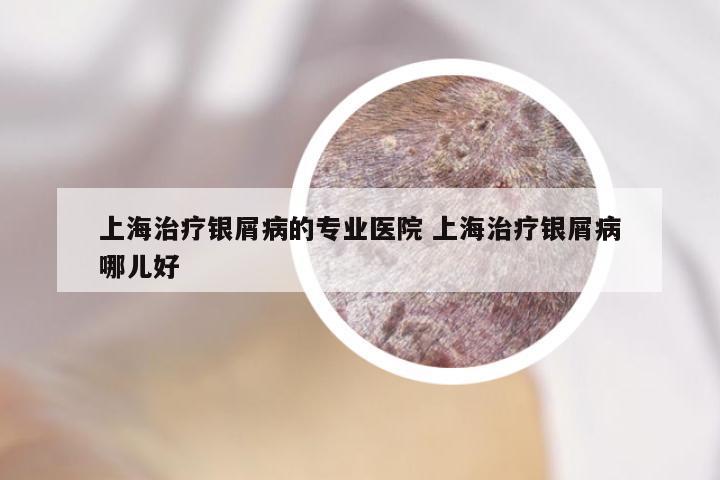 上海治疗银屑病的专业医院 上海治疗银屑病哪儿好
