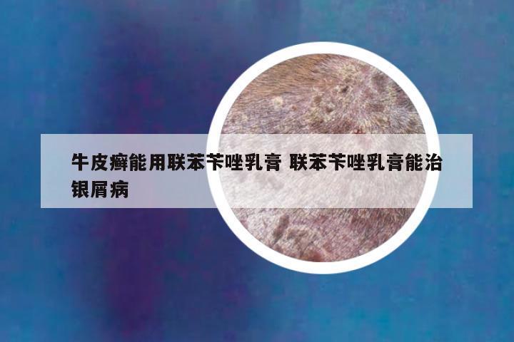 牛皮癣能用联苯苄唑乳膏 联苯苄唑乳膏能治银屑病