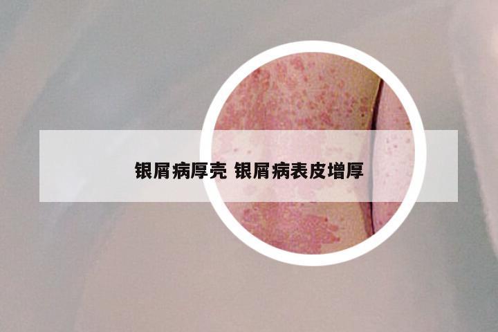 银屑病厚壳 银屑病表皮增厚
