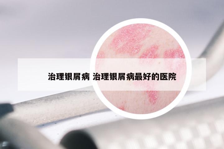 治理银屑病 治理银屑病最好的医院