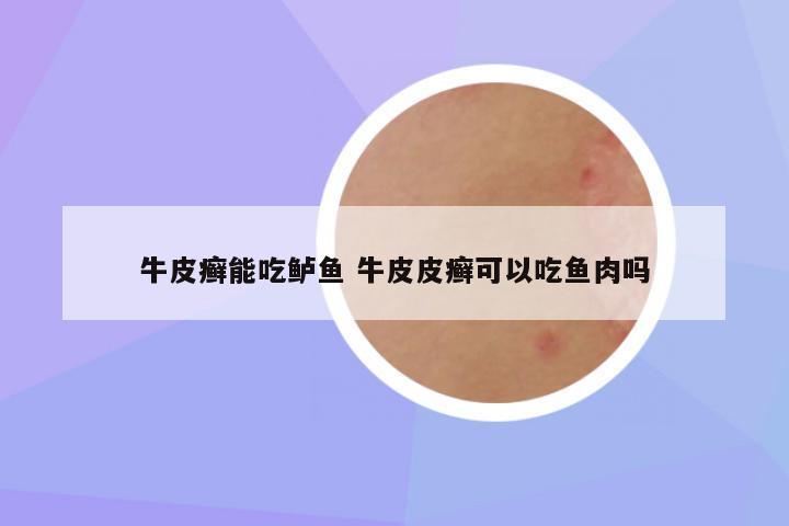 牛皮癣能吃鲈鱼 牛皮皮癣可以吃鱼肉吗