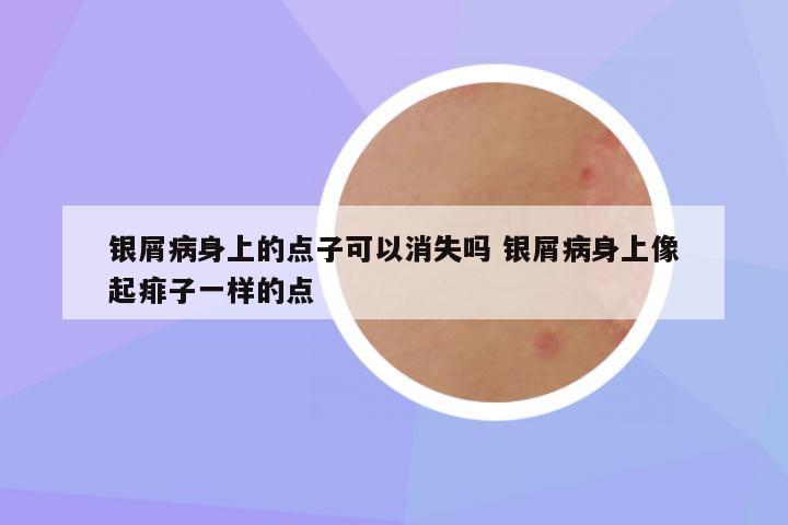 银屑病身上的点子可以消失吗 银屑病身上像起痱子一样的点