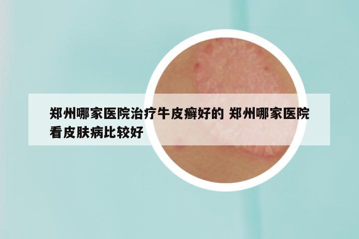郑州哪家医院治疗牛皮癣好的 郑州哪家医院看皮肤病比较好