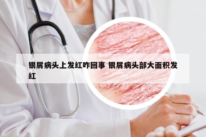 银屑病头上发红咋回事 银屑病头部大面积发红