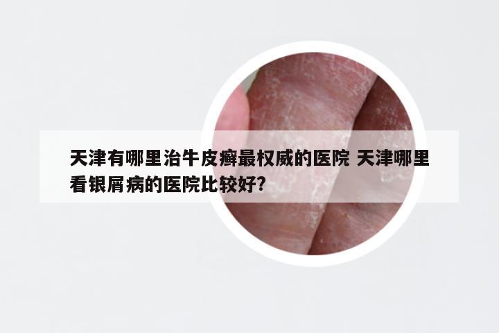 天津有哪里治牛皮癣最权威的医院 天津哪里看银屑病的医院比较好?
