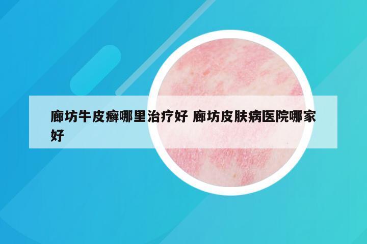 廊坊牛皮癣哪里治疗好 廊坊皮肤病医院哪家好