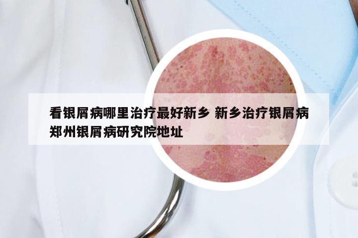 看银屑病哪里治疗最好新乡 新乡治疗银屑病郑州银屑病研究院地址