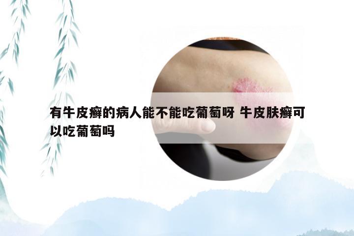有牛皮癣的病人能不能吃葡萄呀 牛皮肤癣可以吃葡萄吗