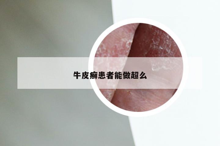 牛皮癣患者能做超么