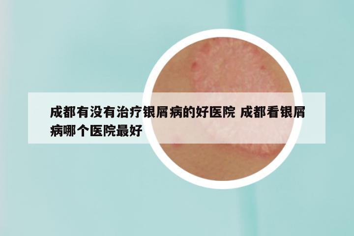 成都有没有治疗银屑病的好医院 成都看银屑病哪个医院最好