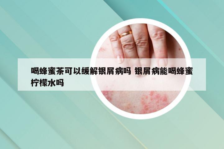 喝蜂蜜茶可以缓解银屑病吗 银屑病能喝蜂蜜柠檬水吗