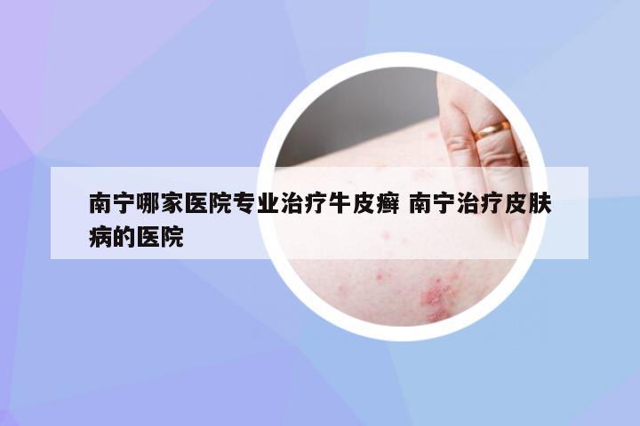 南宁哪家医院专业治疗牛皮癣 南宁治疗皮肤病的医院