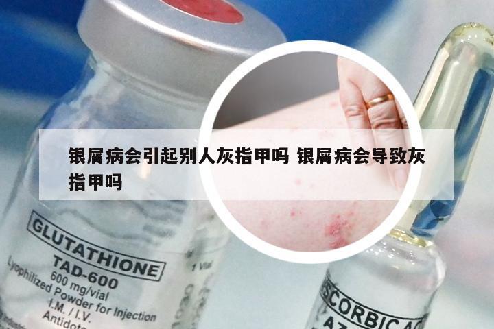 银屑病会引起别人灰指甲吗 银屑病会导致灰指甲吗