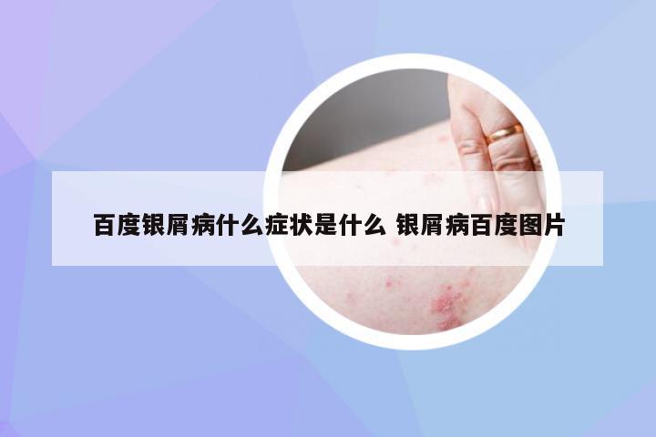 百度银屑病什么症状是什么 银屑病百度图片
