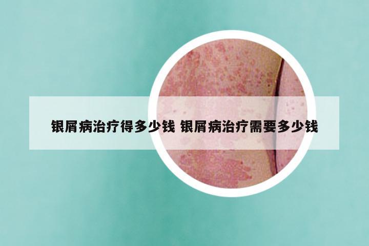 银屑病治疗得多少钱 银屑病治疗需要多少钱