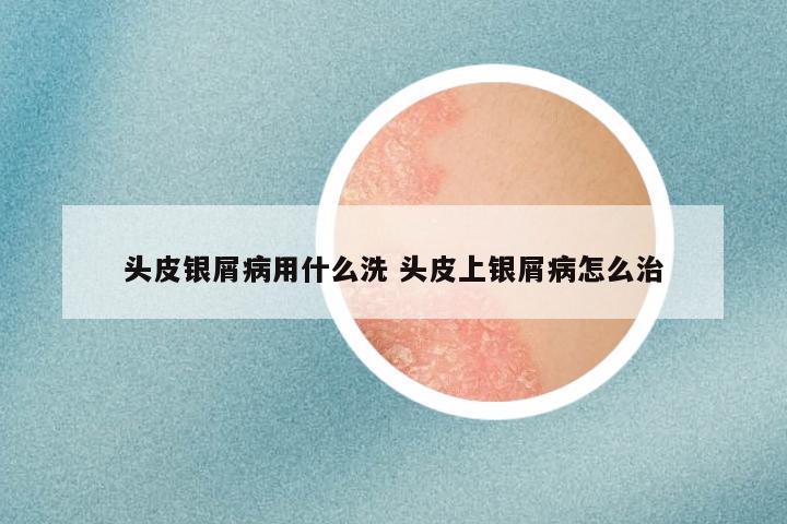 头皮银屑病用什么洗 头皮上银屑病怎么治