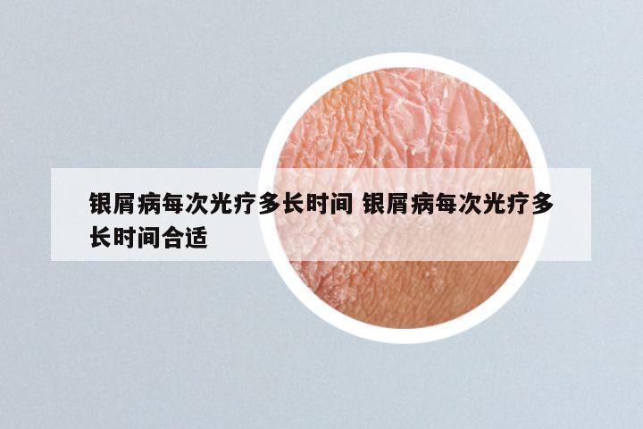 银屑病每次光疗多长时间 银屑病每次光疗多长时间合适
