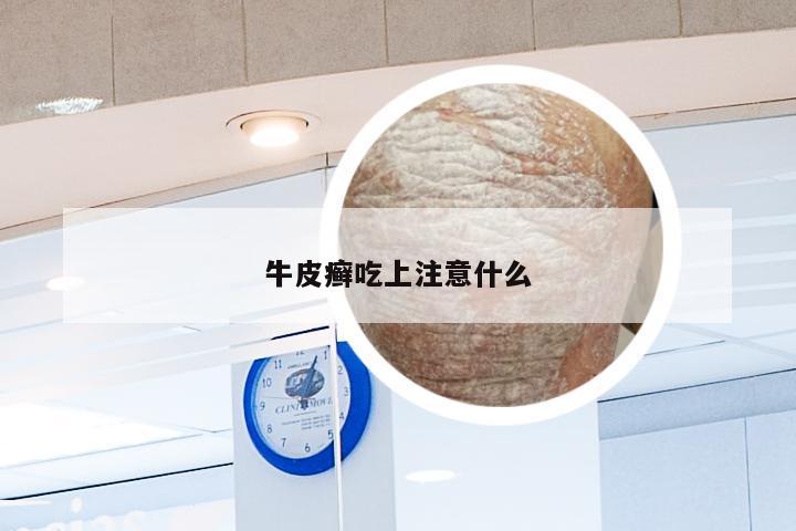 牛皮癣吃上注意什么
