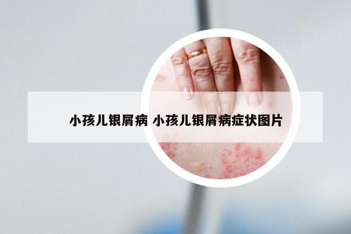 小孩儿银屑病 小孩儿银屑病症状图片