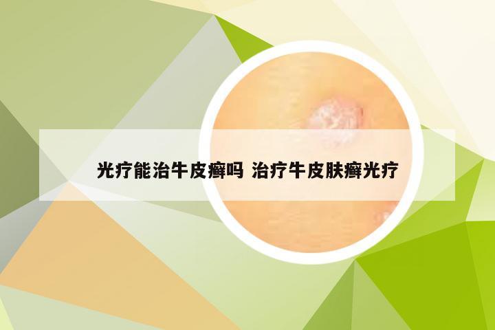光疗能治牛皮癣吗 治疗牛皮肤癣光疗