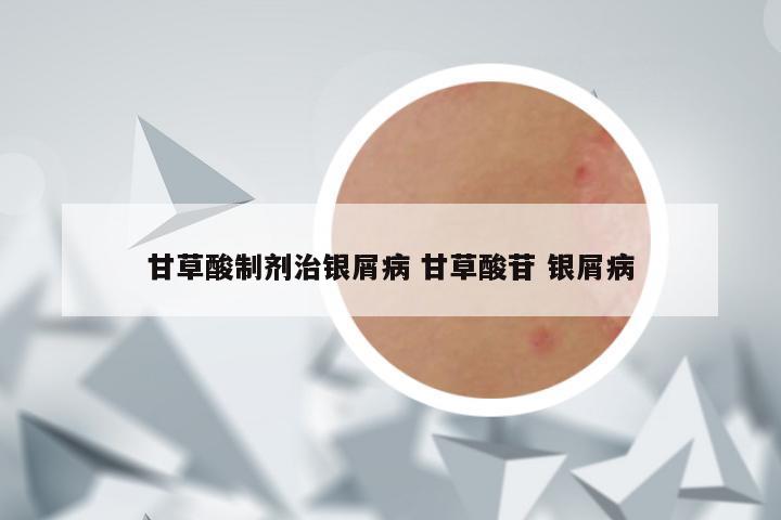 甘草酸制剂治银屑病 甘草酸苷 银屑病