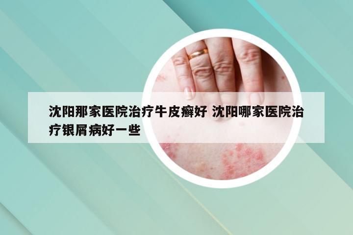 沈阳那家医院治疗牛皮癣好 沈阳哪家医院治疗银屑病好一些