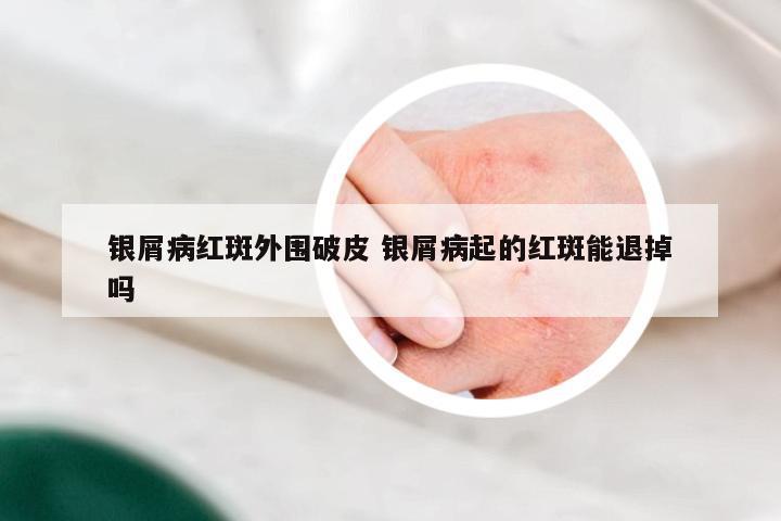 银屑病红斑外围破皮 银屑病起的红斑能退掉吗