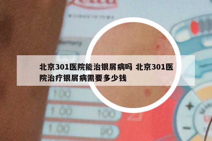 北京301医院能治银屑病吗 北京301医院治疗银屑病需要多少钱