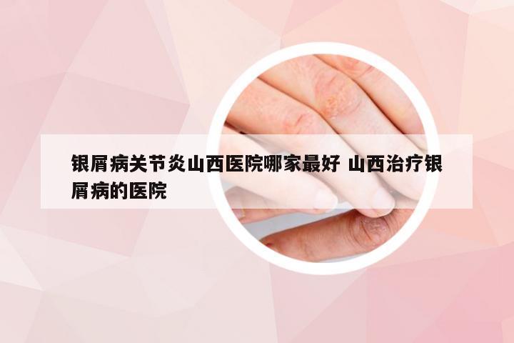 银屑病关节炎山西医院哪家最好 山西治疗银屑病的医院