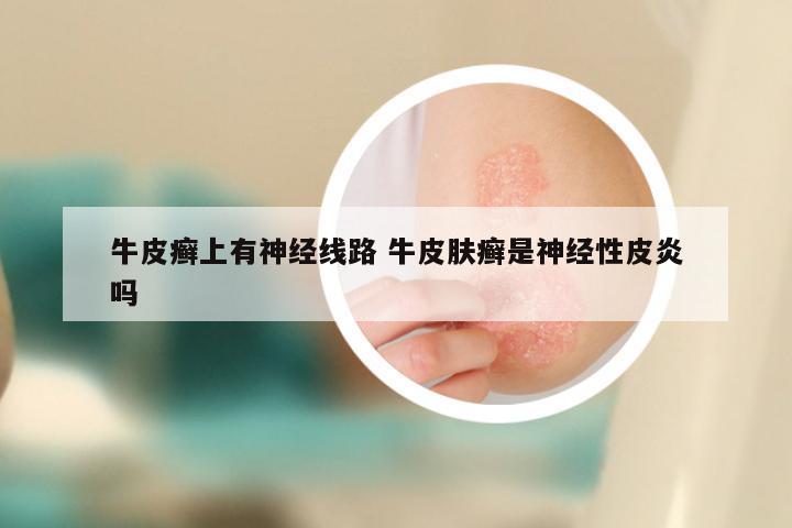 牛皮癣上有神经线路 牛皮肤癣是神经性皮炎吗