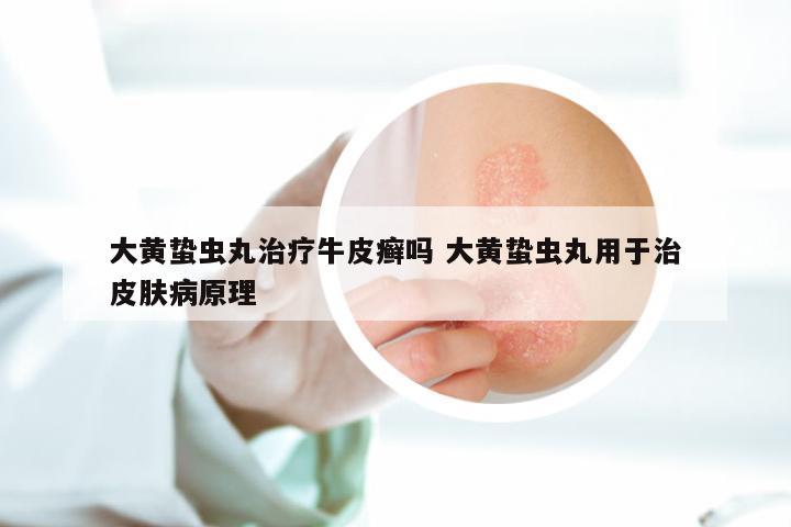 大黄蛰虫丸治疗牛皮癣吗 大黄蛰虫丸用于治皮肤病原理