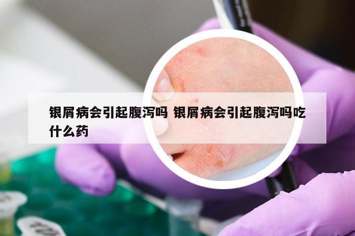 银屑病会引起腹泻吗 银屑病会引起腹泻吗吃什么药
