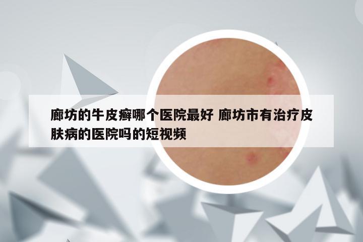 廊坊的牛皮癣哪个医院最好 廊坊市有治疗皮肤病的医院吗的短视频