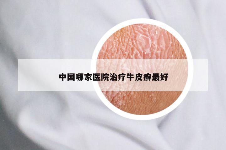 中国哪家医院治疗牛皮癣最好
