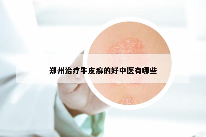 郑州治疗牛皮癣的好中医有哪些
