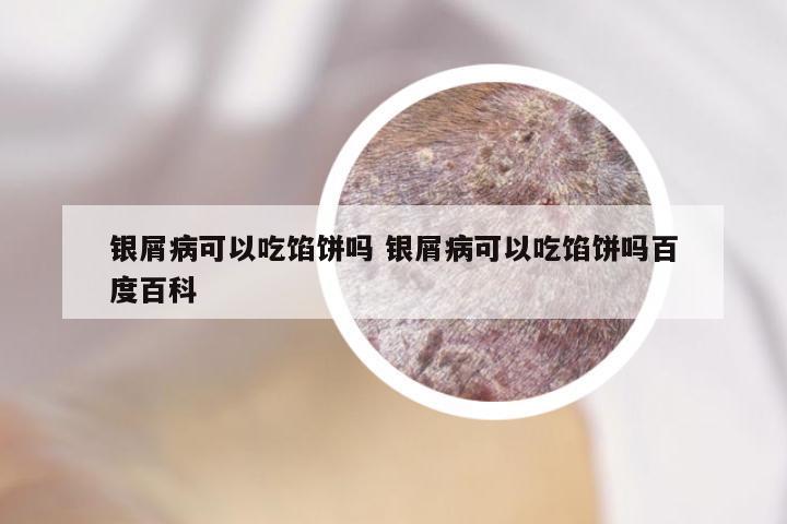 银屑病可以吃馅饼吗 银屑病可以吃馅饼吗百度百科