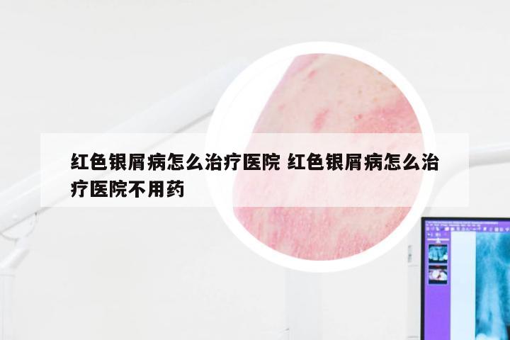红色银屑病怎么治疗医院 红色银屑病怎么治疗医院不用药