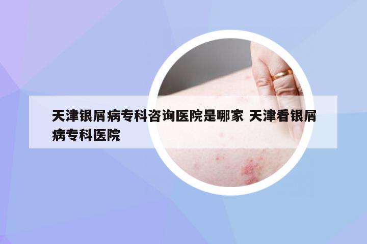 天津银屑病专科咨询医院是哪家 天津看银屑病专科医院