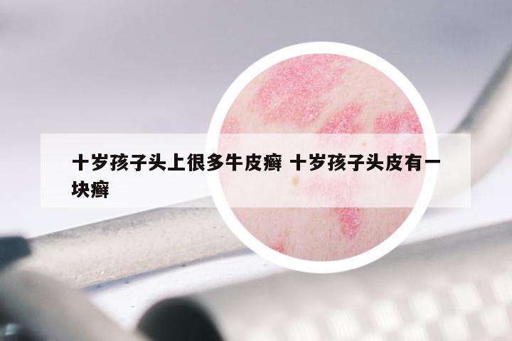 十岁孩子头上很多牛皮癣 十岁孩子头皮有一块癣