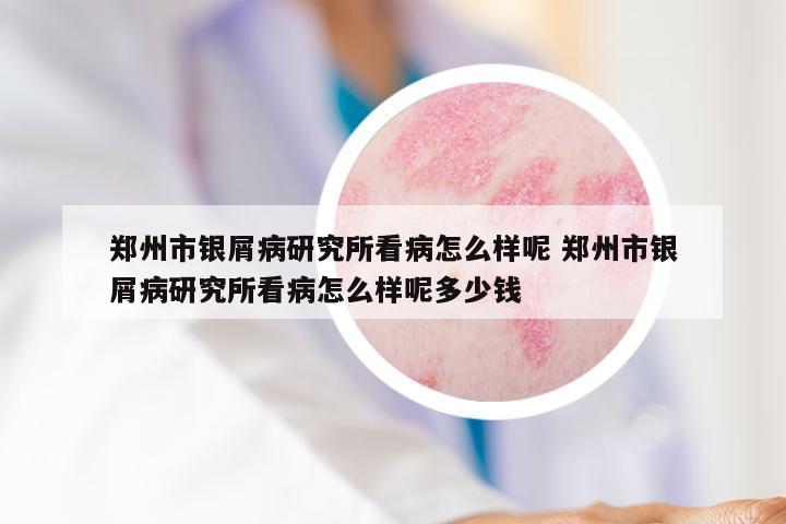 郑州市银屑病研究所看病怎么样呢 郑州市银屑病研究所看病怎么样呢多少钱