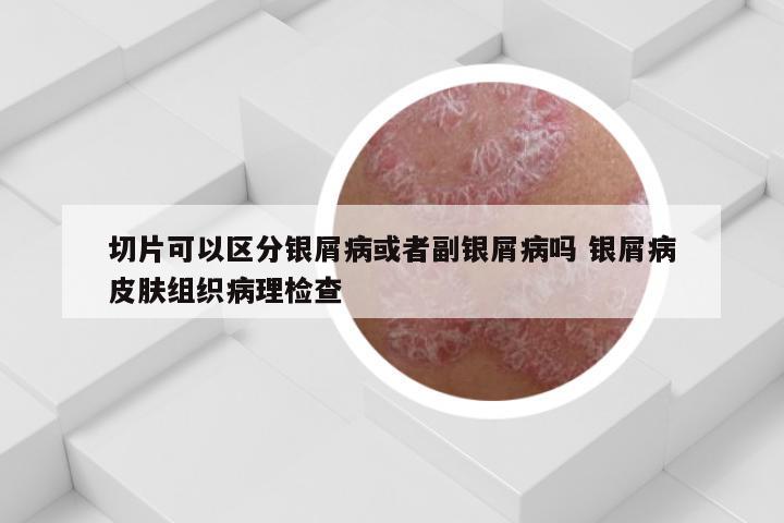 切片可以区分银屑病或者副银屑病吗 银屑病皮肤组织病理检查