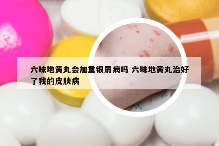 六味地黄丸会加重银屑病吗 六味地黄丸治好了我的皮肤病