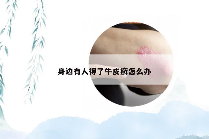 身边有人得了牛皮癣怎么办