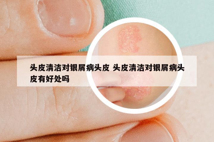 头皮清洁对银屑病头皮 头皮清洁对银屑病头皮有好处吗