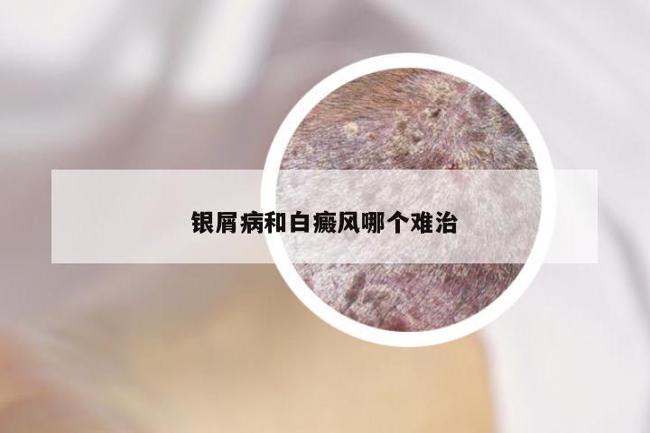 银屑病和白癜风哪个难治