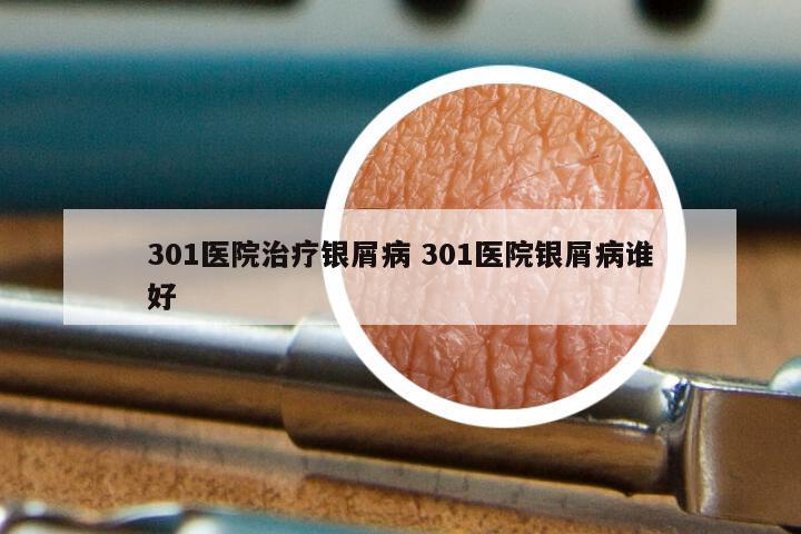 301医院治疗银屑病 301医院银屑病谁好